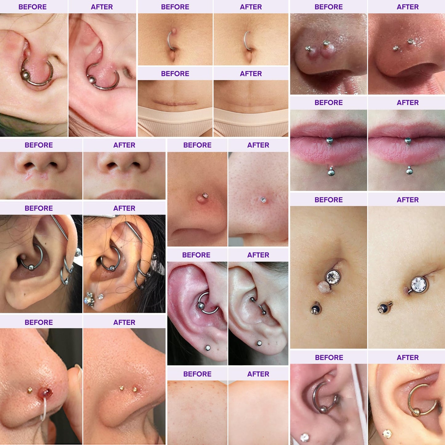 Piercing Keloid Bump Solution Kit - Aftercare Oil (30 mL) and Removal Gel (20 g)