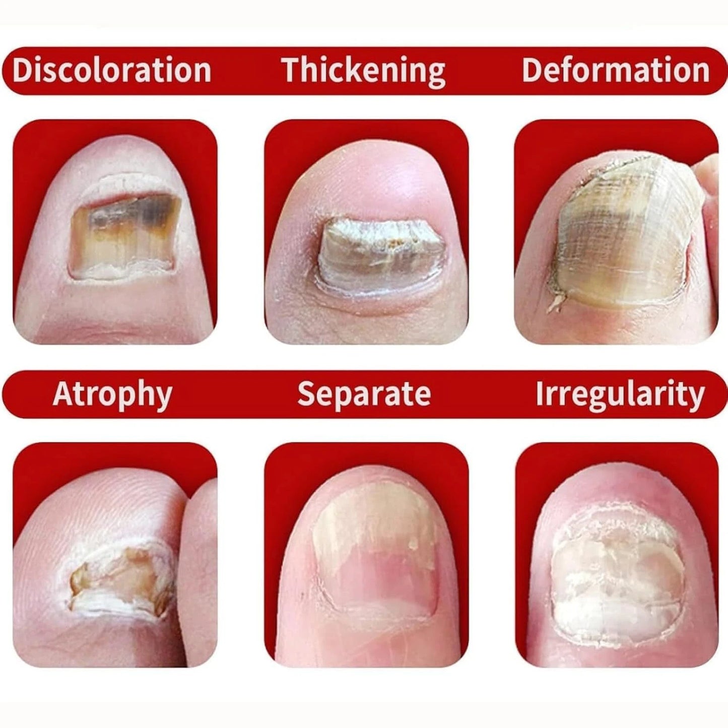 2-Pack Ginger Nail Treatment Serum, Nail Care Oil with Ginger Root Extract, Sunflower Seed Oil, Jojoba Oil & Allantoin, Daily Cuticle & Nail Care